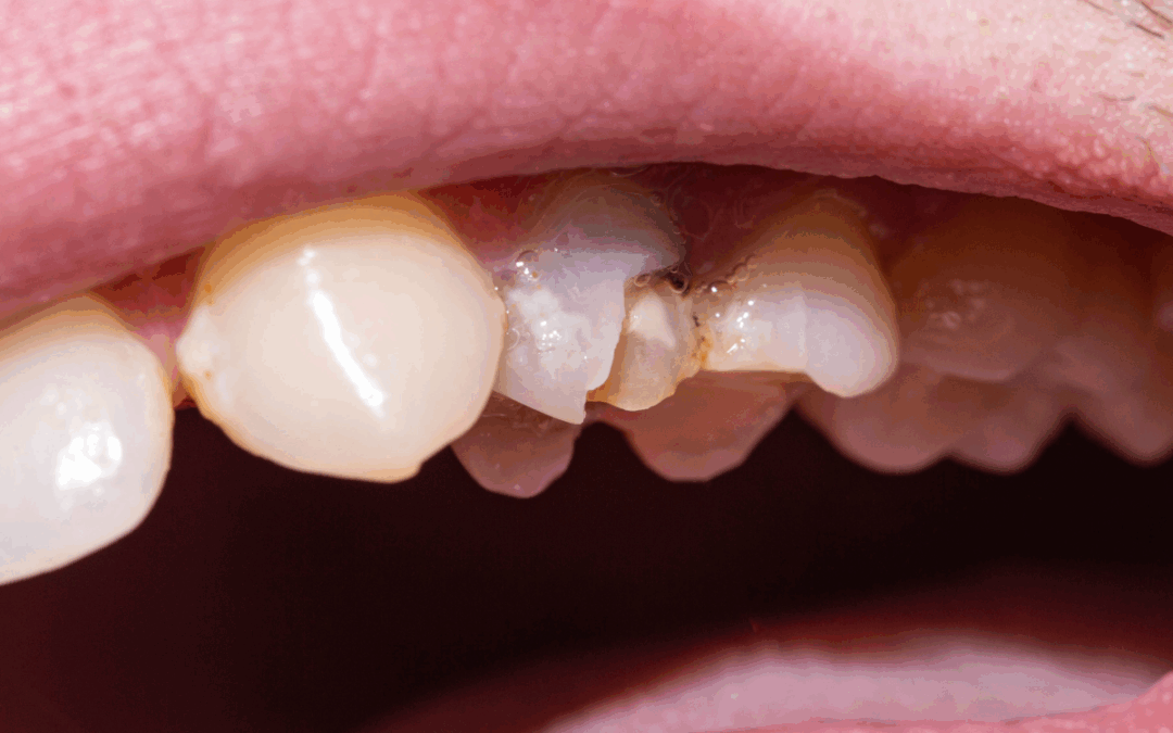 Beyond a Chipped Tooth: How Dentists Restore Damaged Teeth for a Confident Smile
