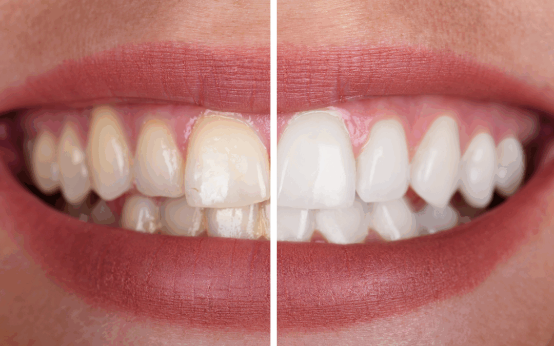 Are Teeth Whitening Strips Safe?