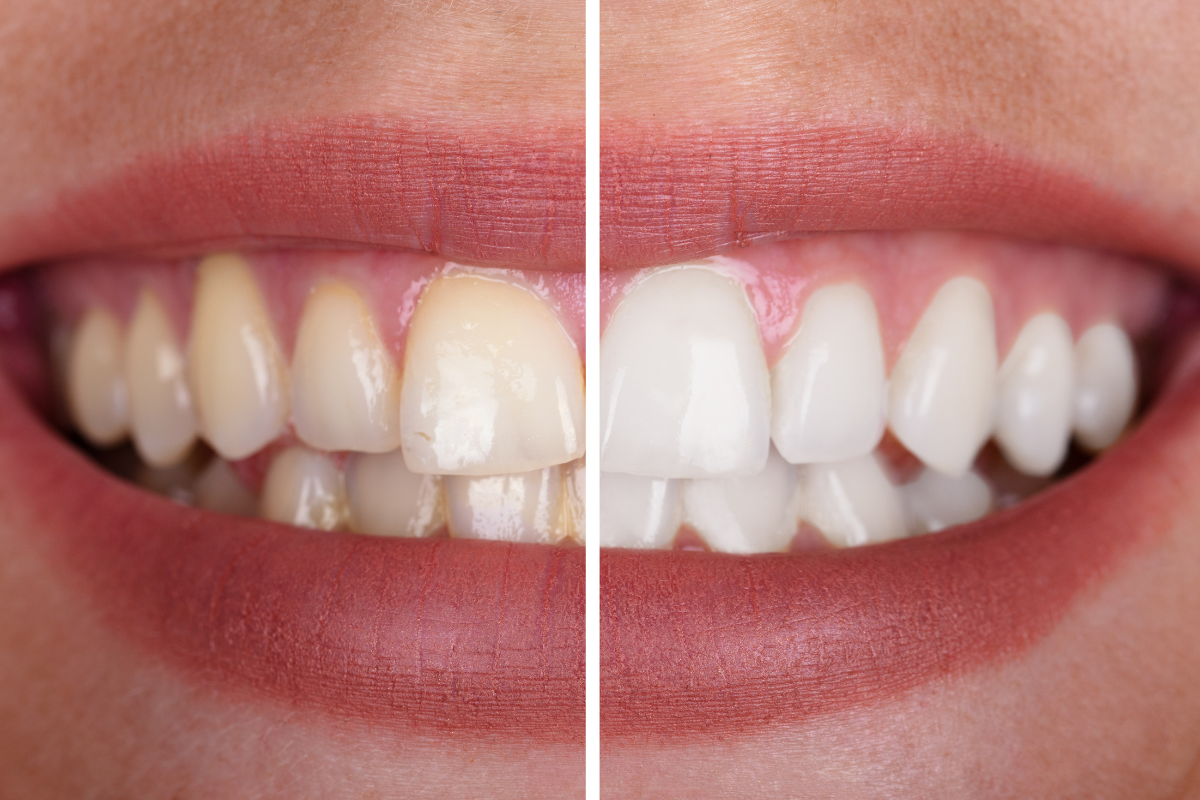 Can Teeth Whitening Damage Gums How to Whiten Safely in Bixby, OK Can Teeth Whitening Damage Gums How to Whiten Safely in Bixby, OK