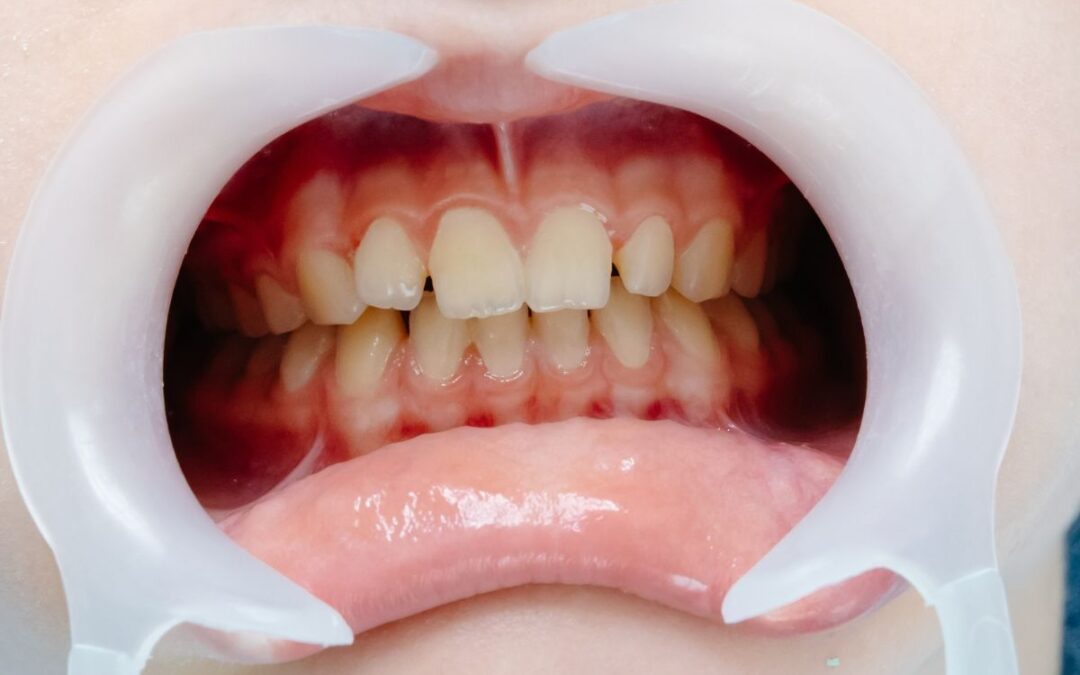 What is the Difference Between Dental Surgery and Oral Surgery?