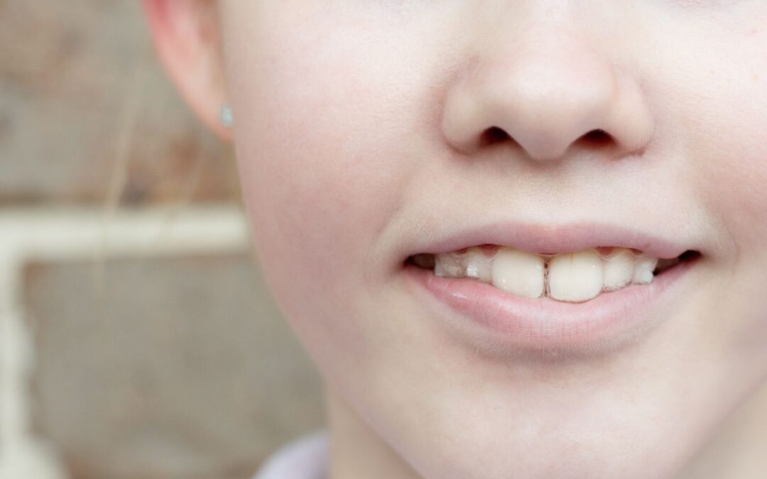 Can Invisalign Fix Underbite?