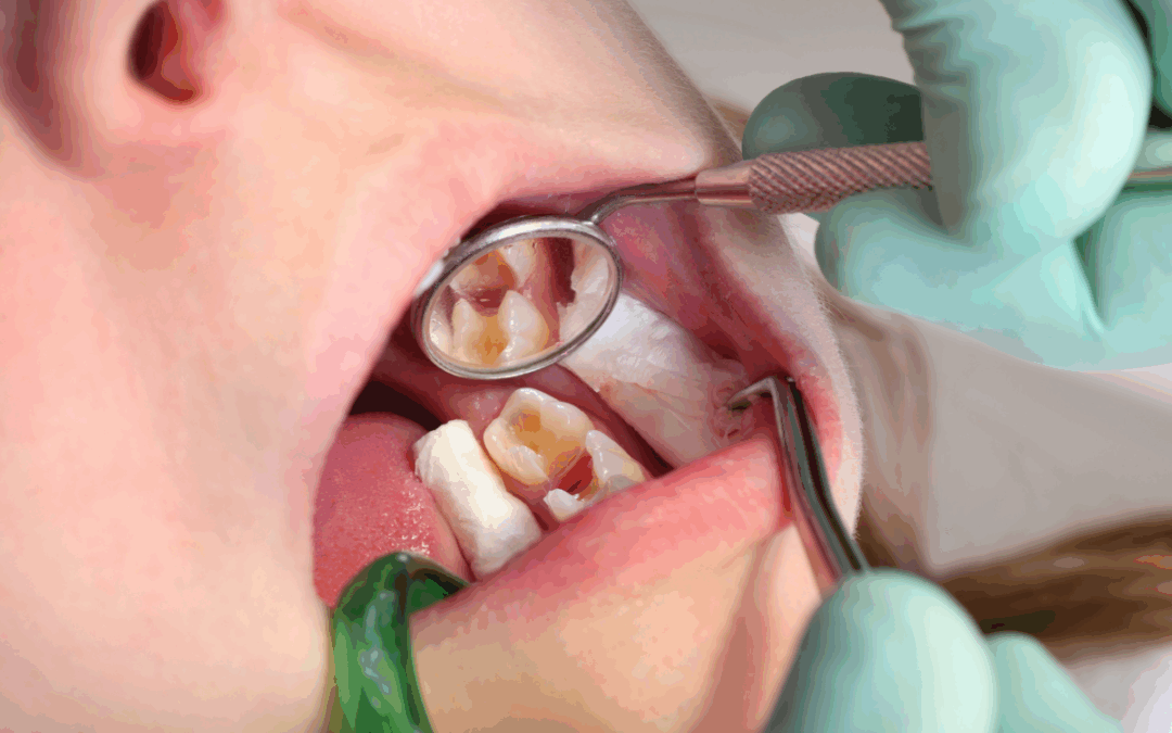 Dental Fillings Explained: Repair, Restore, Rejuvenate Your Teeth