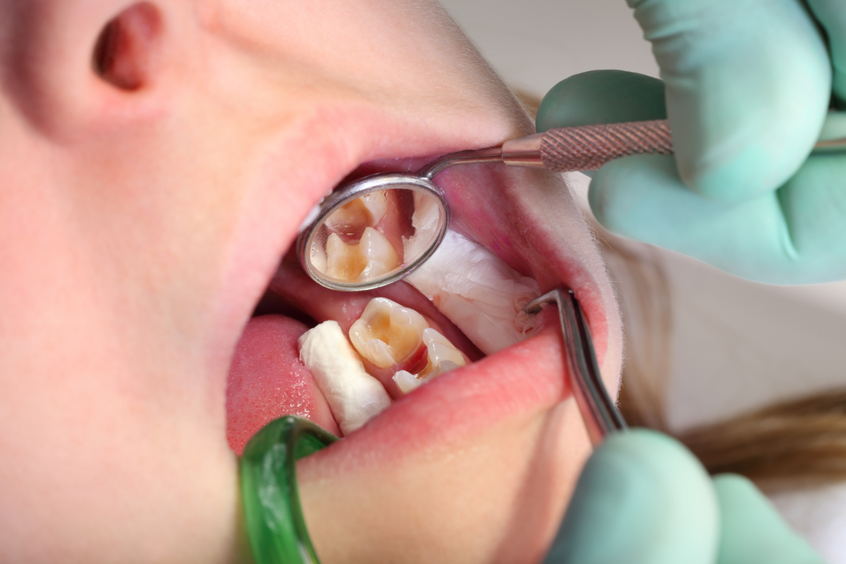 Dental Fillings Explained Repair, Restore, Rejuvenate Your Teeth