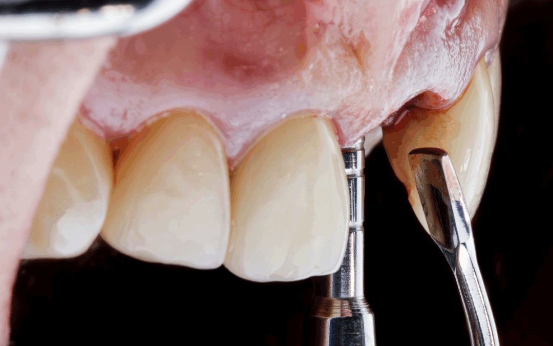 Restore Your Jaw: Advanced Bone Grafting Solutions in Bixby, OK