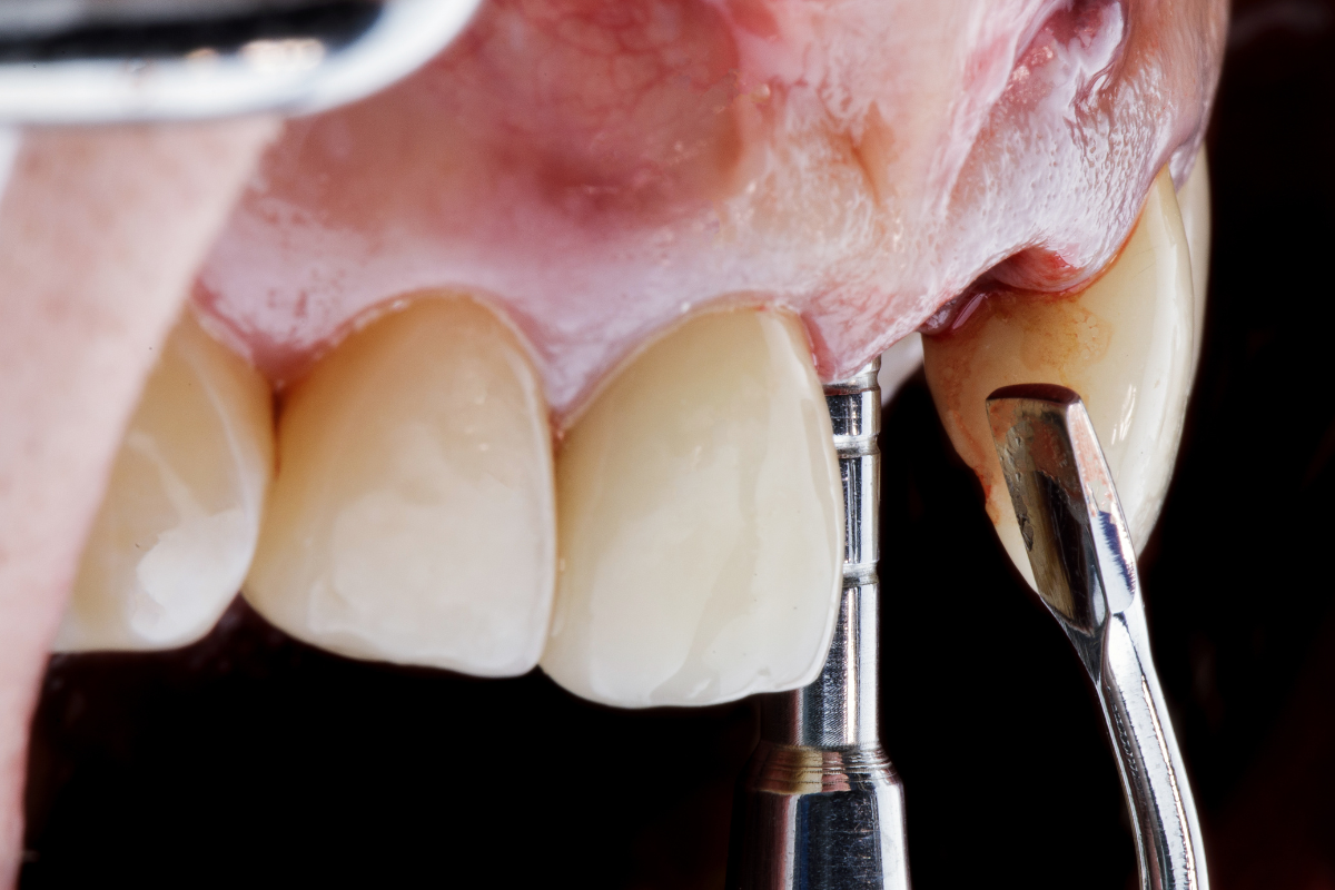 Restore Your Jaw Advanced Bone Grafting Solutions in Bixby, OK