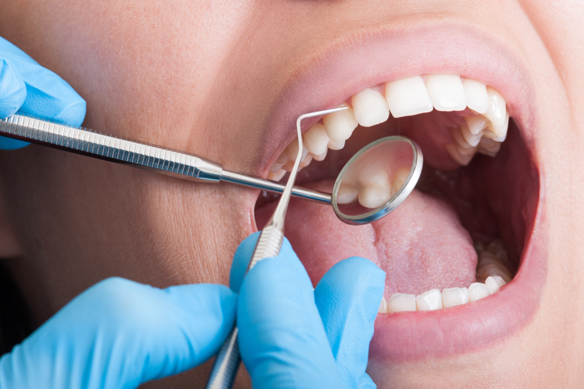 What is Cosmetic Bonding Fixing Chips, Gaps, and Stains Effectively