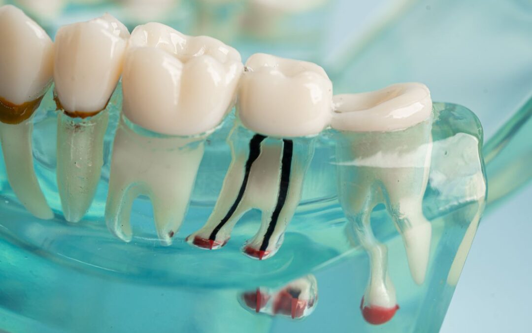 Should Wisdom Teeth Be Removed?