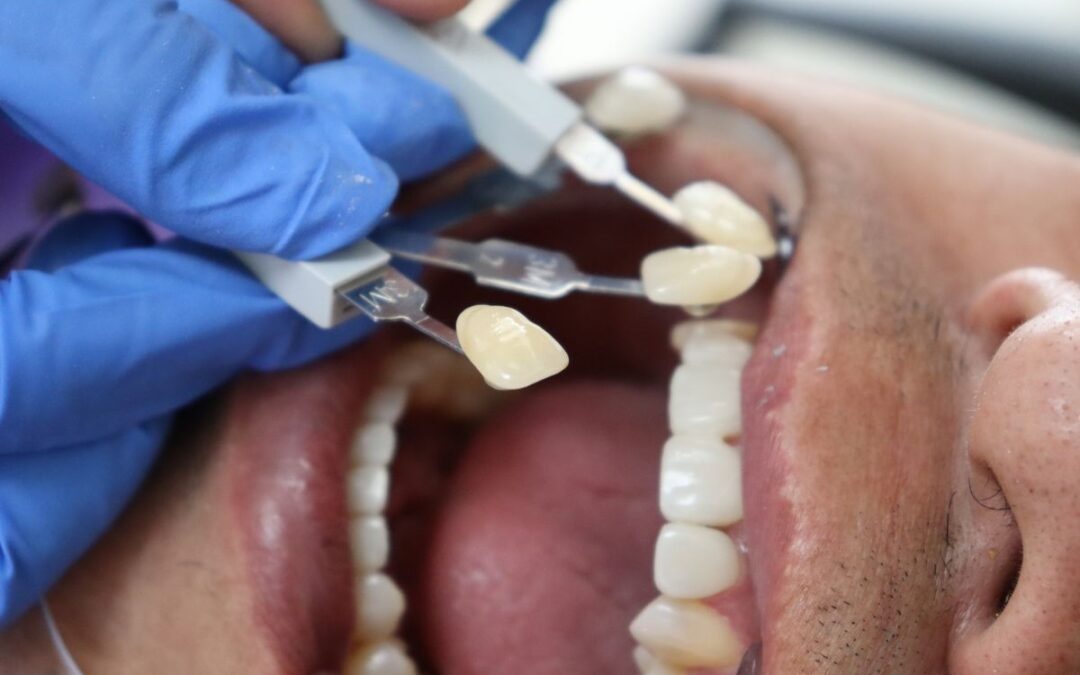 Are Veneers Bad for Your Teeth?