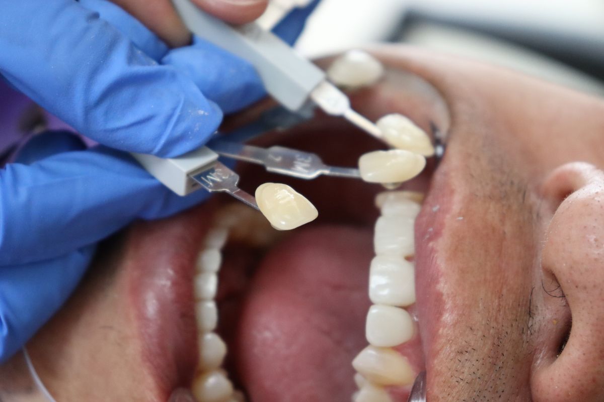 are veneers bad for your teeth