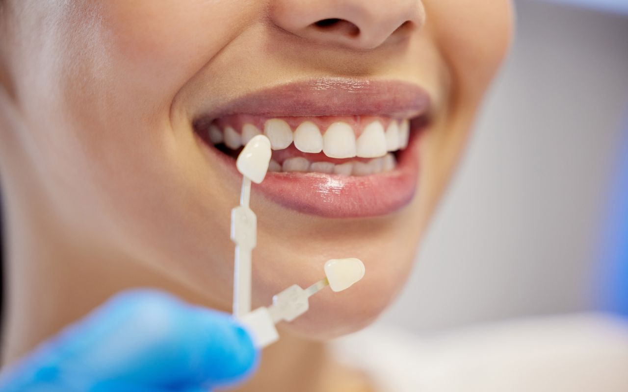 veneers in Bixby