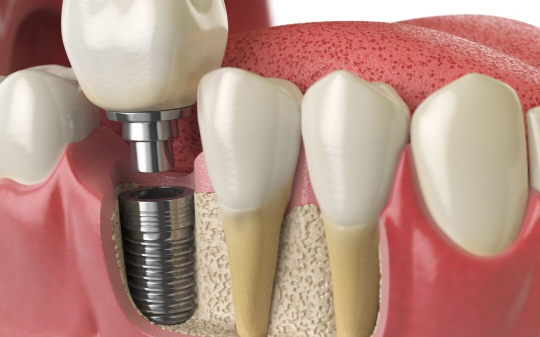 Can Dental Implants Get Infected?