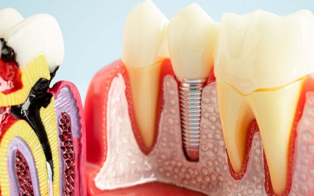 Are Dental Implants Painful? What Patients Must Know