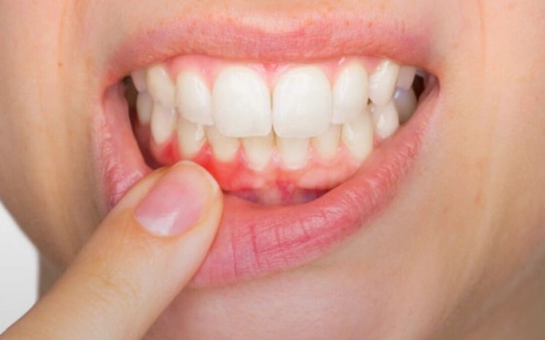 Is Sparkling Water Actually as Bad for My Teeth as Soda?