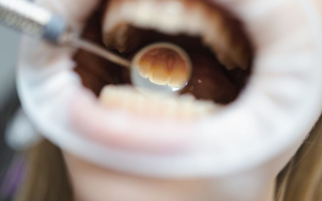 When Does a Dentist Recommend a Deep Cleaning?