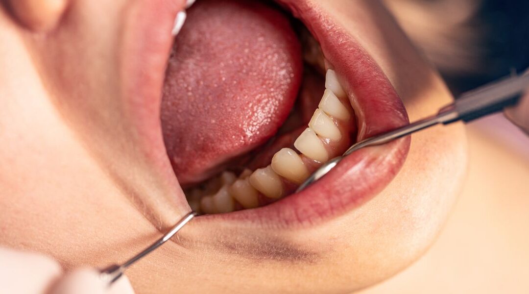 Why Is One Tooth Suddenly Turning a Different Color Than the Rest?