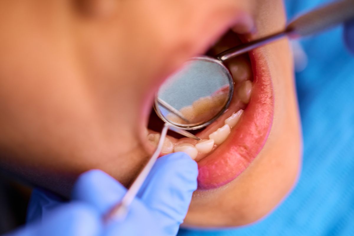 Why Your Dental Fillings Keep Failing
